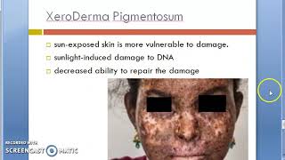 Pathology 761 d Skin XeroDerma Pigmentosum Stratum spinosum pre malignant lesion melanin [upl. by Ajin875]