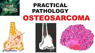 OSTEOSARCOMA Clinical  Radiological features amp Morphology [upl. by Nitin]