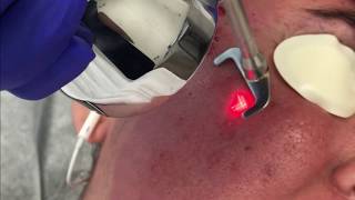 Acne Scar Laser Surgery [upl. by Ailaro]