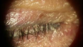 Demodex Before and After 12 Minutes of Removal from Eyes [upl. by Poock]