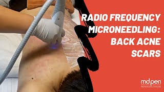 RF Microneedling Back Acne Scars Treatment [upl. by Bobbe305]