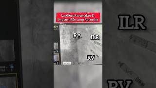 Leadless Pacemaker amp Implantable Loop Recorder on fluoroscopy heart Cardiology [upl. by Siuoleoj]