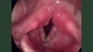 Laryngeal Tuberculosis TB [upl. by Nenerb]