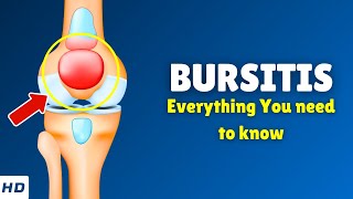 Bursitis – Types Causes Signs and Symptoms Diagnosis amp Treatment [upl. by Eryn]