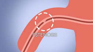 Animación uretroplastia con balón con Paclitaxel [upl. by Ros]