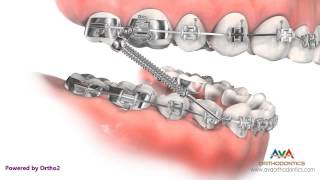 Orthodontic Treatment for Overjet Overbite  Forsus Appliance [upl. by Nnaeerb]