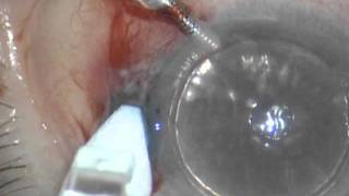 Sutureless DSEAK cornea transplantation using and ocular sealant Resure2011 [upl. by Dylana]