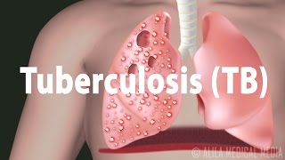 Tuberculosis TB Progression of the Disease Latent and Active Infections [upl. by Kliber]