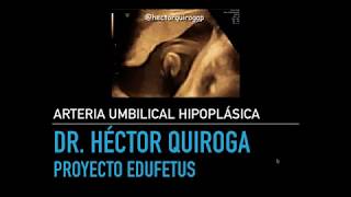 Ecografía morfológica Arteria Umbilical Hipoplásica [upl. by Annatnas]