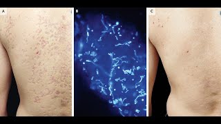 Atrophische Pityriasis versicolor [upl. by Zobkiw]