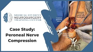 Case Study Peroneal Nerve Compression [upl. by Velvet458]