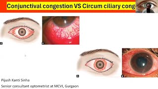 Conjunctival congestion VS circum cilliary congestion explained with slit lamp pics [upl. by Anipsed172]