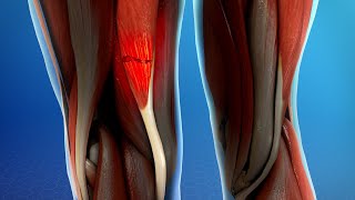 Hamstring Muscle Injuries [upl. by Bahr]