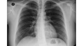 Chest xray  Asbestosis  Pleural calcifications  Round atelectasis [upl. by Vinita300]