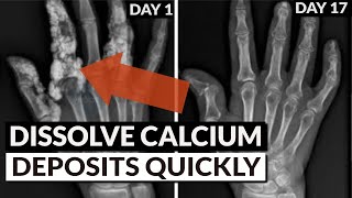 Reverse Soft Tissue Calcification Bring Calcium Out Of Tissue amp Into Bones [upl. by Yttig]