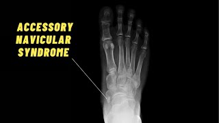 BEST Exercises for Accessory Navicular Syndrome [upl. by Rickie]