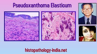 Pathology of Pseudoxanthoma Elasticum  Dr Sampurna Roy MD dermpath dermatopathology [upl. by Alsworth]