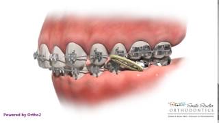 Elastics  Class II  Orthodontic Treatment [upl. by Ellenoj]