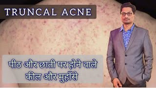 पीठ और छाती पर होने वाले कील और मुहाँसे Truncal Acne pimplessolution acnetreatment acne pimples [upl. by Theadora]