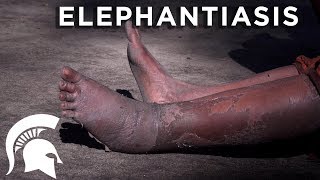 Spartans fight elephantiasis in Tanzania [upl. by Alesig]