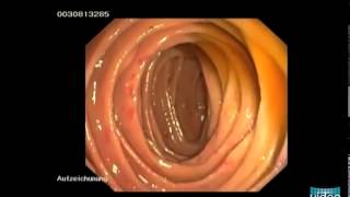 Hereditary Hemorrhagic Telangiectasia OslerWeberRendu Disease [upl. by Nehemiah251]