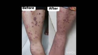 STOP SKIN PROBLEMS WITH HOMOEOPATHY [upl. by Marduk]