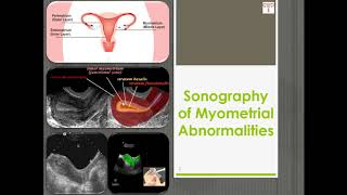 Sonography of Myometrial Abnormalities [upl. by Udella977]