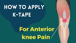 How to treat Knee Pain Patellofemoral Pain syndrome using Kinesiology tape [upl. by Acie]