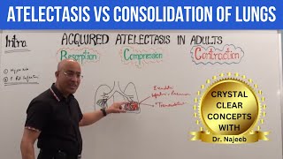 Atelectasis vs Consolidation of Lungs  Respiratory Pathology🫁 [upl. by Remos]