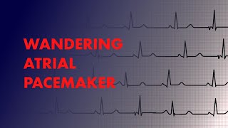 Wandering Atrial Pacemaker  EKG ECG Interpretation [upl. by Gypsy]