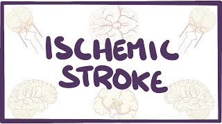 Ischemic Stroke  causes symptoms diagnosis treatment pathology [upl. by Yhpos]