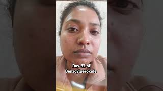 Day 32of Benzoylperoxide benzoylperoxide skincare acne benzac indianpharmacy [upl. by Teiv]