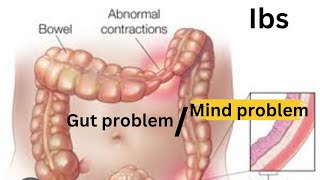 IBS gut problem Vs mind problemcolitis indigestionacidgasacidityconstipation [upl. by Velvet]