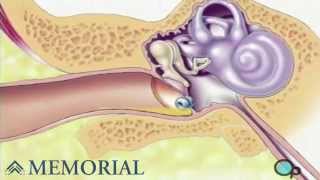 Myringotomy Insertion of Tube Ear Surgery [upl. by Esnahc]