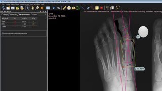 TraumaCad Foot Osteotomies Wizard [upl. by Cerellia]