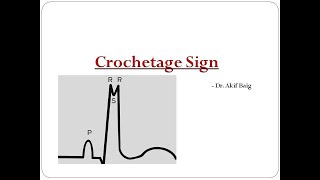 Crochetage sign in ASD  Dr Akif Baig [upl. by Ertsevlis]