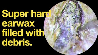 Super hard earwax filled with debris ear wax removal  ear cleaning  ASMR  relaxation  relax [upl. by Lindblad]