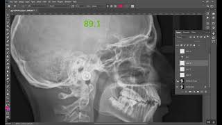 Cephalometrics Part 1 المرحلة الخامسة [upl. by Alebasi]