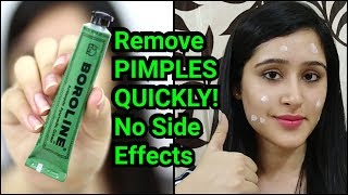 Remove PIMPLES amp ACNE IN 3 DAYS  NATURAL amp EASY METHOD [upl. by Oalsinatse]