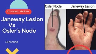 Janeway Lesions Vs Oslers Nodes Simplified Approach [upl. by Nylaroc]