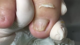 Calo subungueal tratamento com peeling [upl. by Sudhir274]