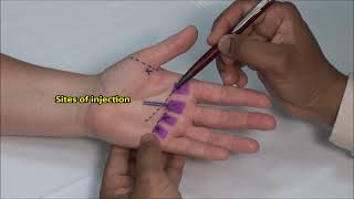 Flexor Tendonitis Hand Injection [upl. by Oznole]