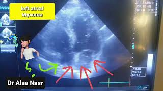 left atrial Myxoma Echo Dr Alaa Nasr 2023  what is the structure in the right atrium [upl. by Wallis]