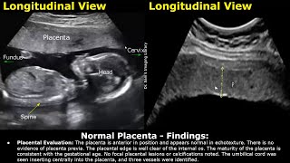 Placenta Ultrasound Reporting  How To Write Pregnancy USG Reports  Pathologies amp Positions Scans [upl. by Htenay946]