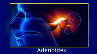 Adenoides Que Es  Los Adenoides Como Detectarlas Consecuencias y Tratamiento [upl. by Eladroc11]