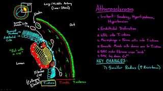 Atherosclerosis  Part 2 [upl. by Capon572]