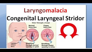 ENT 348 a Laryngomalacia congenital laryngeal stridor inspiratory [upl. by Petrie]