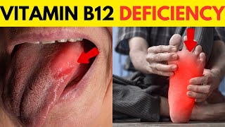 Vitamin B12 Deficiency Symptoms  B12 Deficiency  Vitamin B12  All You Need to Know [upl. by Ennovyhc711]