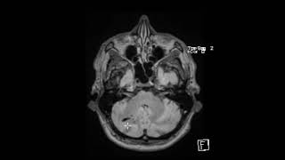 Venous Angioma developmental venous malformation [upl. by Thant]