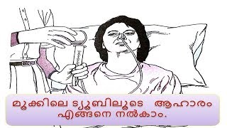 RYLES TUBE FEEDING Malayalam  How to give food through tube malayalam [upl. by Redle]